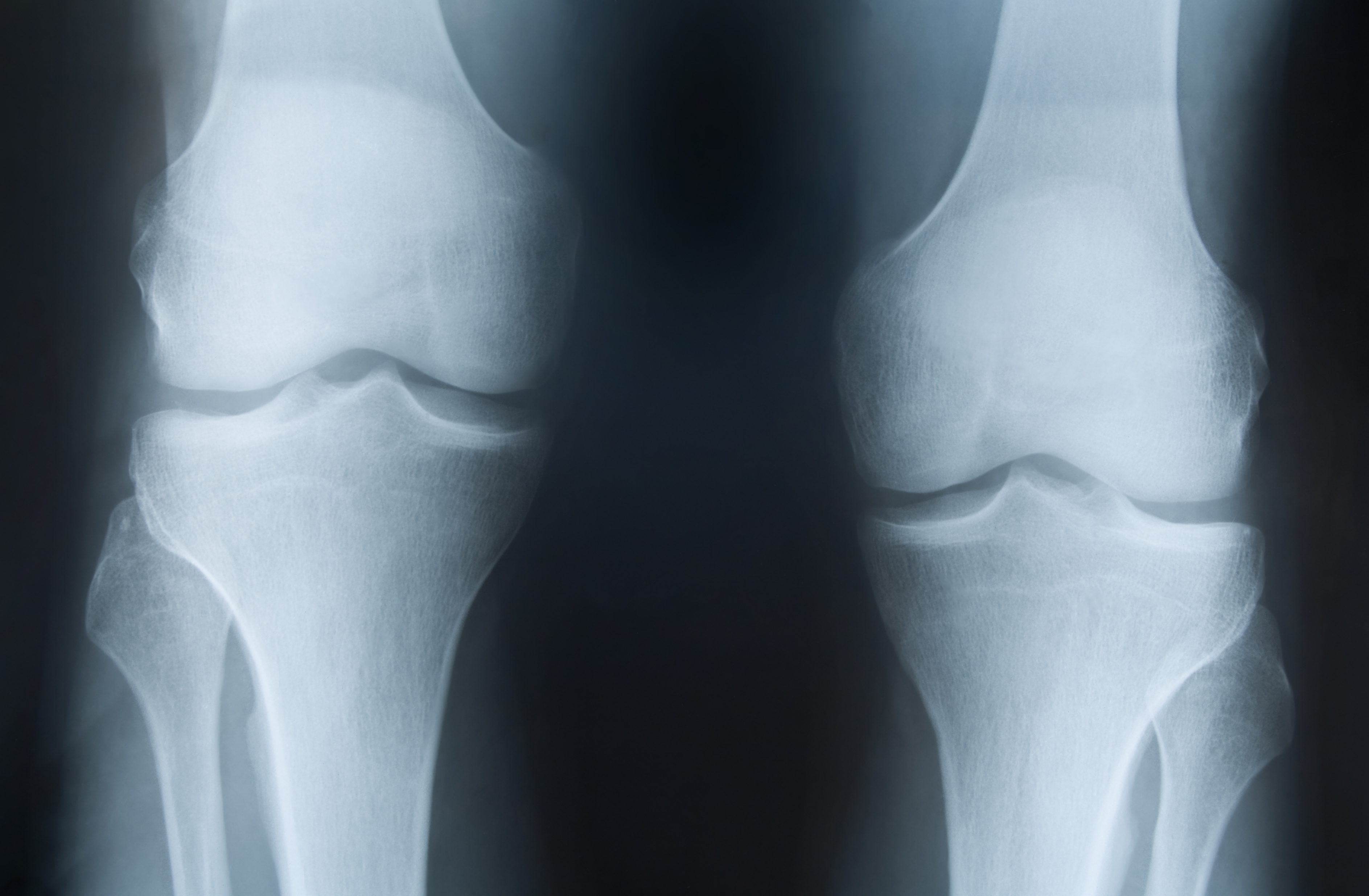 Plochá chodidla zapříčiňují nohy do X